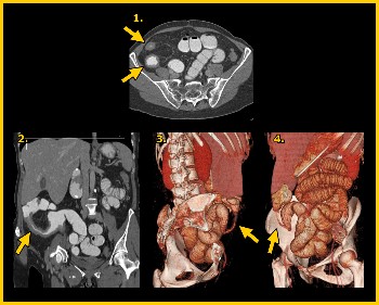 crohn