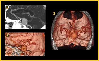 aneurysma