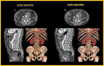aorta